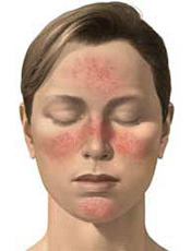 woman acne rosacea skin care image